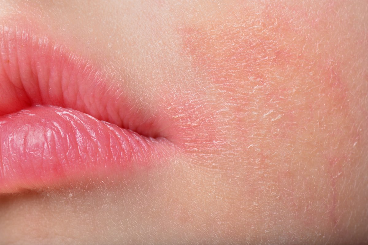 allergichesky-dermatit-prichiny