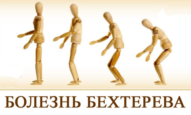 От египетских мумий до наших дней – болезнь Бехтерева