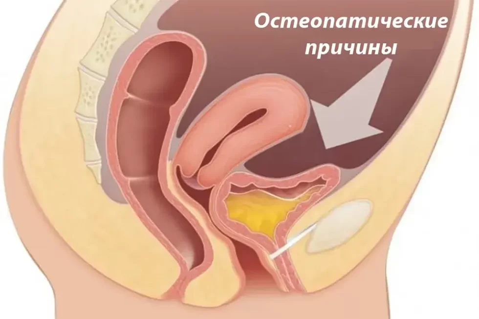 Стрессовое недержание мочи: что может сделать остеопат